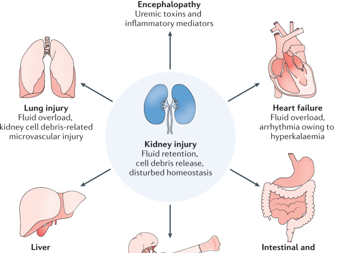 Understanding the Concept of Acute Kidney Injury!